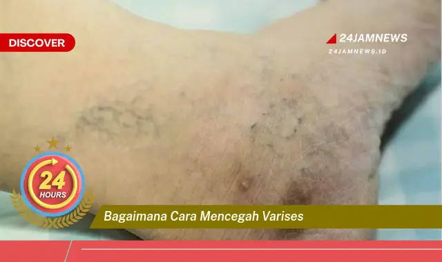 bagaimana cara mencegah varises