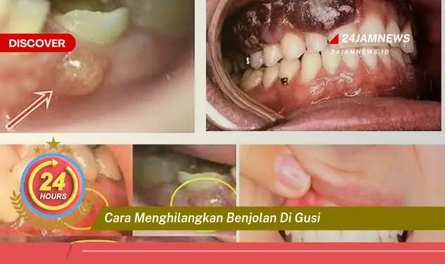 cara menghilangkan benjolan di gusi