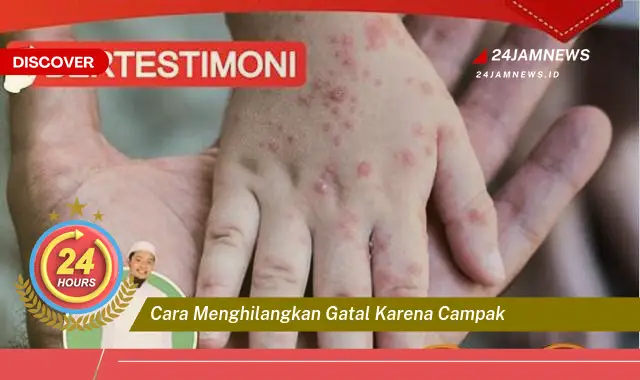 cara menghilangkan gatal karena campak