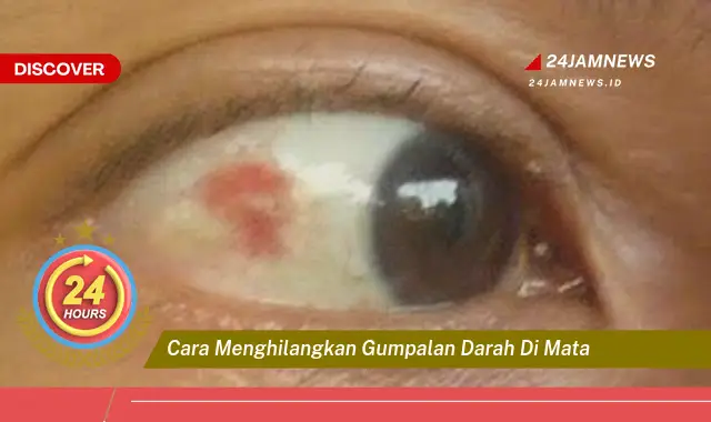 cara menghilangkan gumpalan darah di mata
